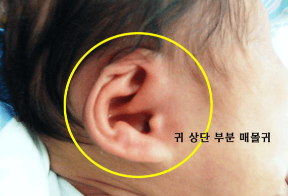 매몰귀2